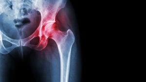 膝の痛み　股関節の問題